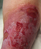 venous leg ulcer before
