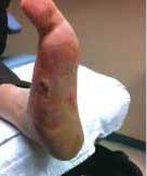 healing a diabetic foot ulcer
