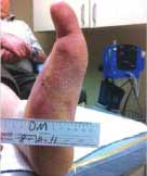 healed diabetic foot ulcer